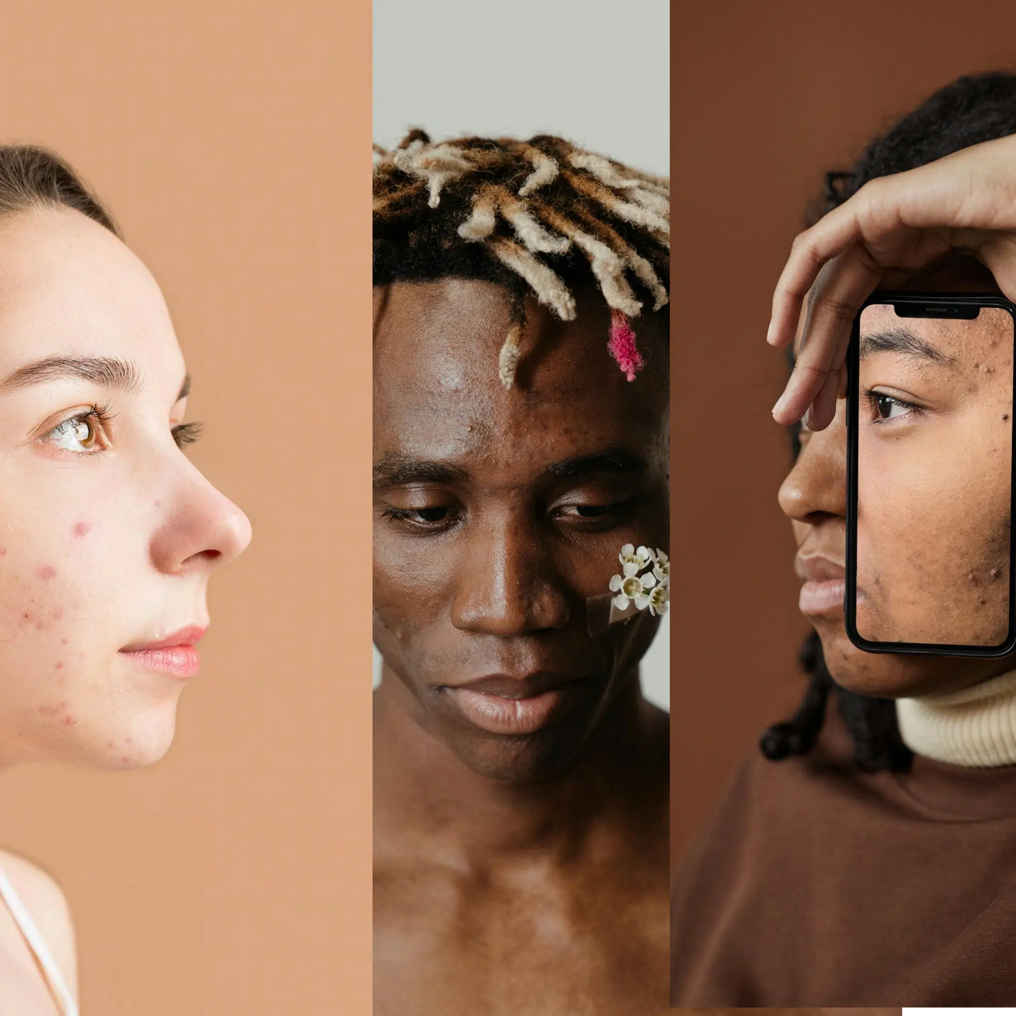 Demystifying Teen Acne
